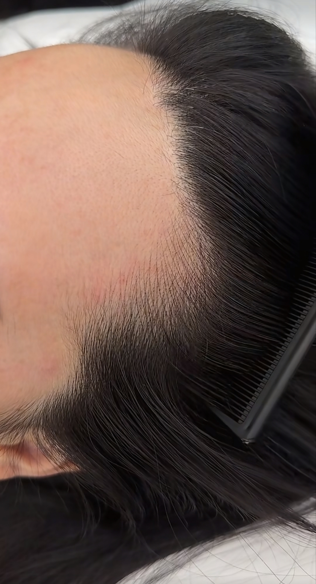 Professional natural hairline embroidery procedure and result
